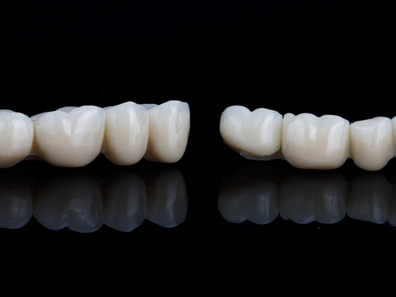 Dental Bridges Dallas TX