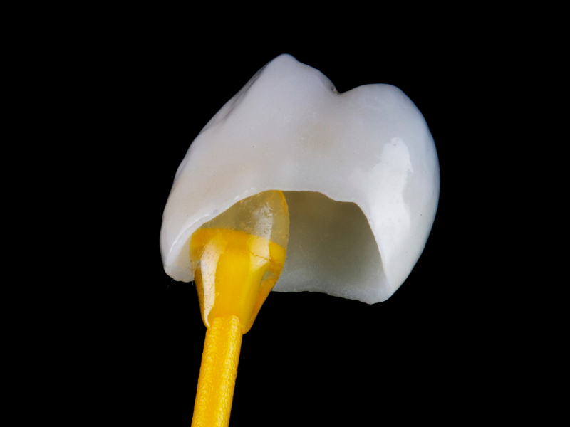 Dental Crown Dallas TX