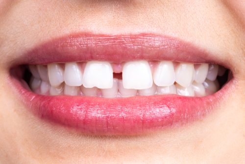 Ways to Fix Teeth Gaps