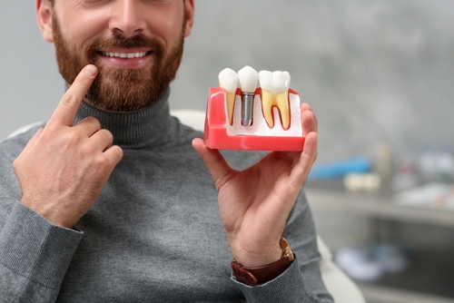 Dental Implants