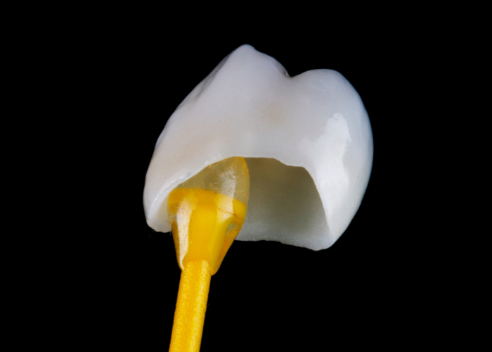 Dental Crowns