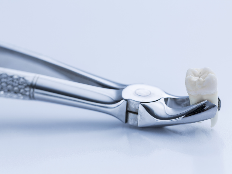 tooth extraction Dallas