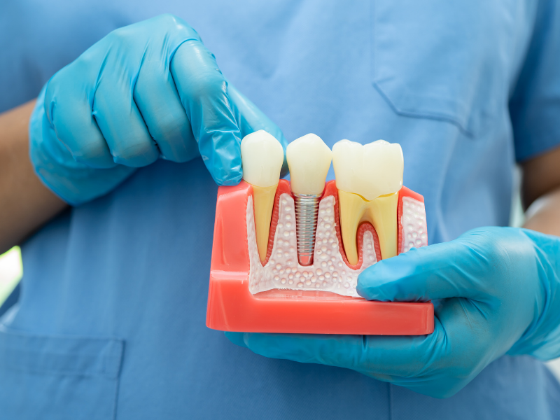 Dental Implant Dallas TX